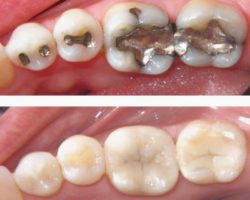 Lead Vs White fillings Lead Vs White fillings