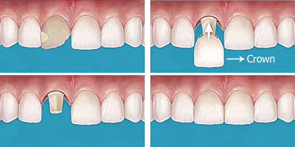 5-things-to-expect-when-getting-a-dental-crown