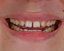 img-01-Veneers img-01-Veneers