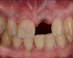 img-01-dental-bridge img-01-dental-bridge