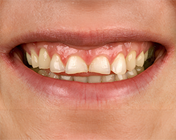 img-01-dental-crown img-01-dental-crown