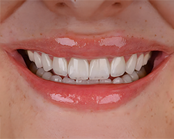 img-02-Veneers img-02-Veneers