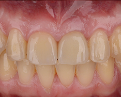 img-02-dental-bridge img-02-dental-bridge