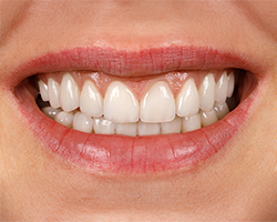 img-02-dental-crown img-02-dental-crown